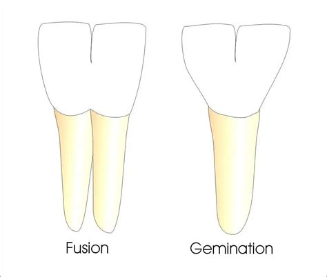 What is Tooth Fusion & Gemination? - Ask an Orthodontist.com