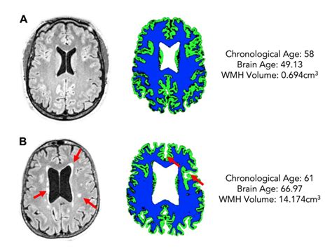 White matter hyperintensity load is associated with premature brain aging