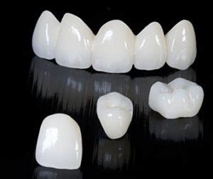 All Ceramic Crowns and Bridges - Cynthia E. Paquette DDS