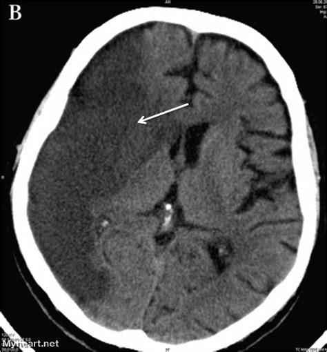 Stroke Ct Scan