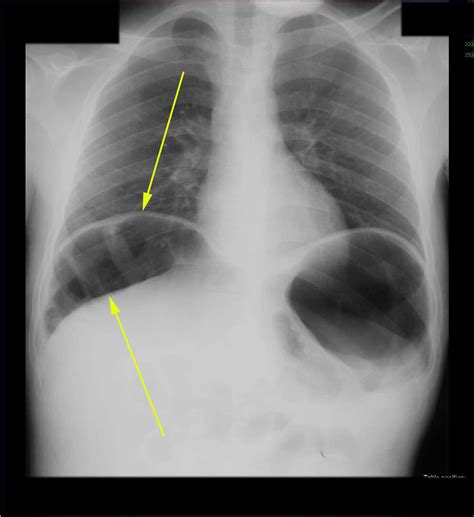 Interposition of colon under right Hemidiaphragm on X-ray - X Rays Case ...