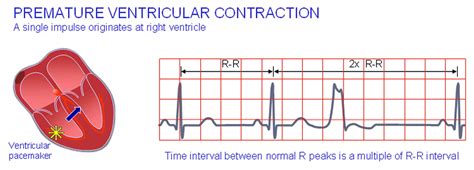 Premature Ventricular Contraction