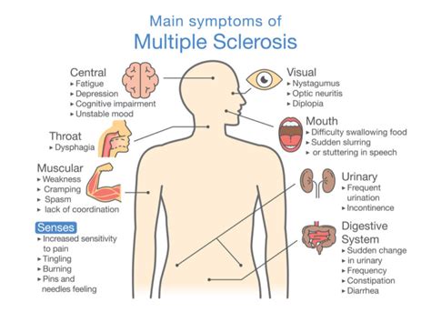 MS Explained: Physical Therapy Treatment for Multiple Sclerosis