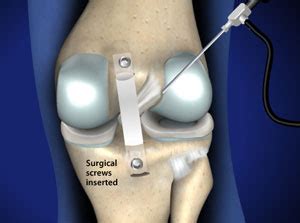 Posterior Cruciate Ligament (PCL) Reconstruction in Plano, Frisco ...