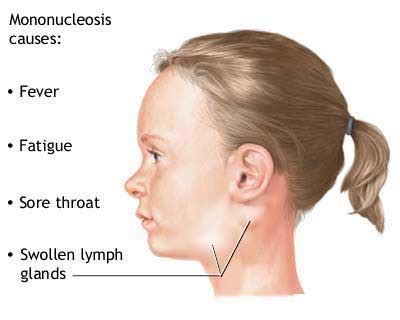 Mononucleosis Symptoms - Healthy future