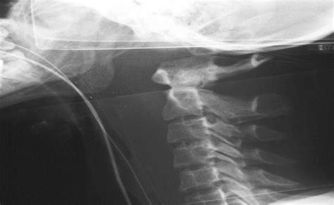 Traumatic Atlanto-Occipital Dislocation With Atlantoaxial Su... : Spine