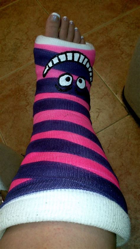 Pin by Vicki Vergas-Gannuscio on CMT | Ankle cast, Arm cast, Leg cast