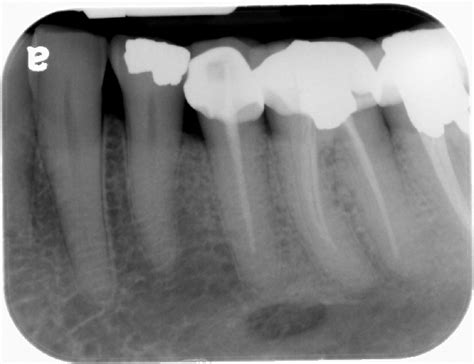 Mental Foramen – Dr. G's Toothpix