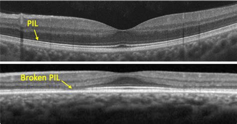 Retinal Toxicity – Hydroxychloroquine