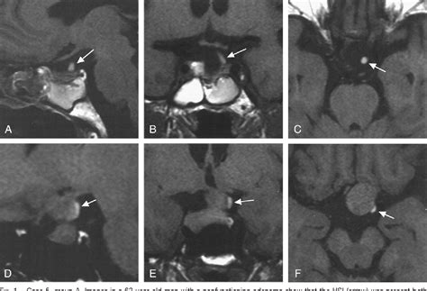 Figure 1 from Correlation of high signal intensity of the pituitary ...