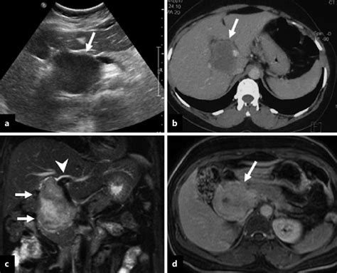 a Ultrasound image shows a hypoechoic mass (arrow) at the porta ...