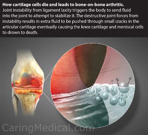 Synovial Joint Knee