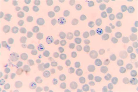 How are reticulocytes counted? • The Blood Project