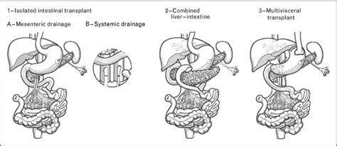 Technical refinements in small bowel transplantation : Current Opinion ...