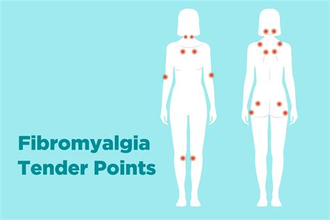 Back Pressure Points Chart