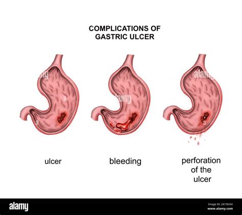 Complications of gastric ulcer. Bleeding and perforation Stock Photo ...