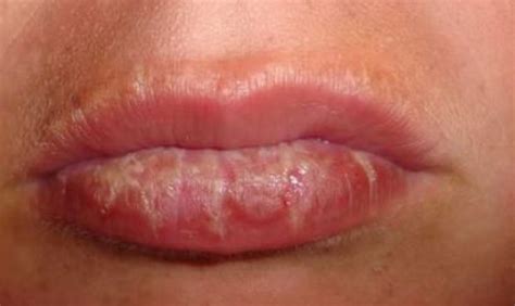 Sunburned Lips Symptoms: Blistered and Swollen Relief - Skincarederm