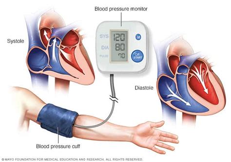 High blood pressure (hypertension) - Diagnosis and treatment - Mayo Clinic