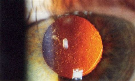 Cataract surgery - wikidoc