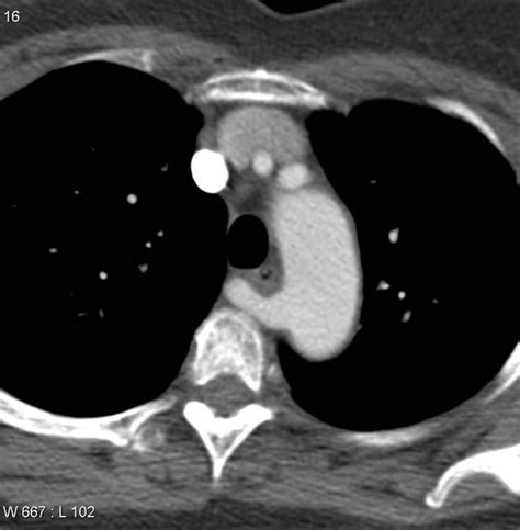 Aberrant right subclavian artery (CTA) = arteria lusoria - often asymptomatic, but may complain ...