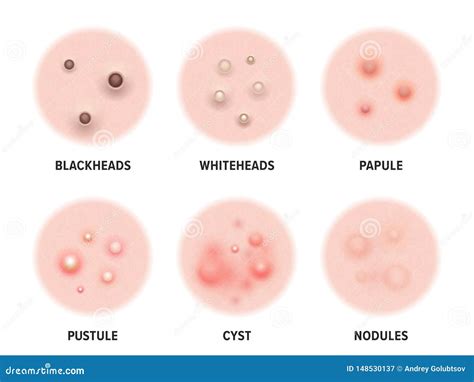 Skin Acne Types Diagram. Vector Skin Disease Pimples Blackheads and Comedones, Cosmetology and ...