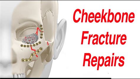 Tripod & Other Cheekbone Facial Fractures - YouTube