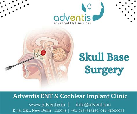 Skull Base Surgery & Treatment in Delhi - Top Skull Base Surgeons ...