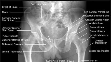 Pelvic Bone Landmarks