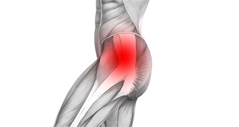 Hip Synovitis - Symptoms, Causes, Treatment & Rehabilitation