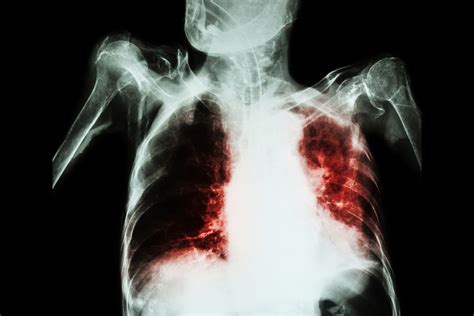 AAEM Resident and Student Association : Drowning in your own Blood: Managing Massive Hemoptysis