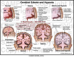 Cerebral Edema and Hypoxia Medical Illustration Medivisuals