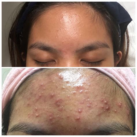 [Acne] 1 Year After Tretinoin Update : r/SkincareAddiction