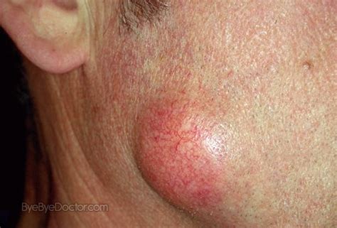 Epidermoid Cyst - Pictures, Treatment, Removal, Symptoms, Causes