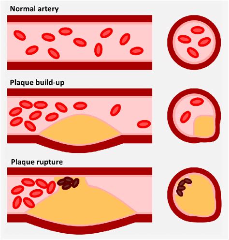 Atherosclerosis Plaque Development