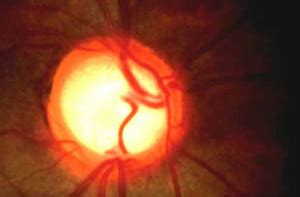 What is glaucoma, and how do I know if I have it?