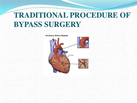 Replacement of bypass surgery by nanorobots 10