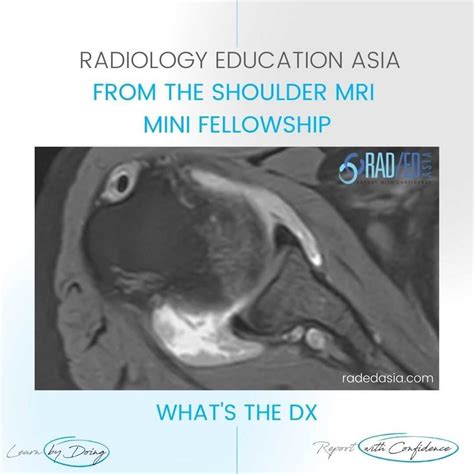 SHOULDER SYNOVITIS MRI RHEUMATOID ARTHRITIS - Radedasia