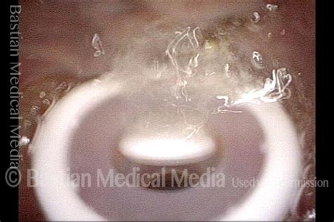 Tracheoesophageal voice prosthesis (TEP) - Laryngopedia