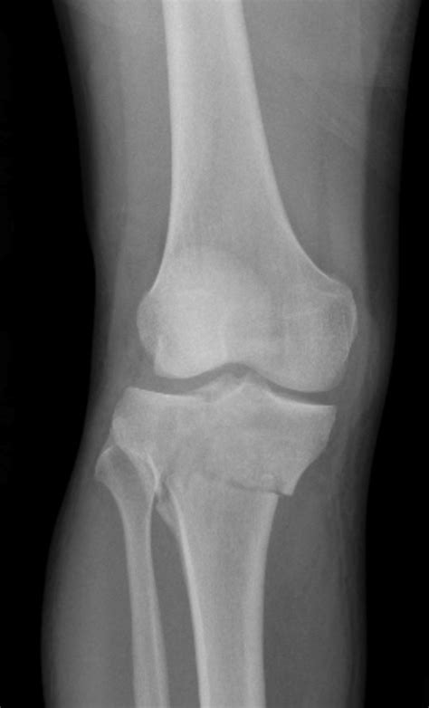 Knee Trauma – Acute Fractures – Undergraduate Diagnostic Imaging ...