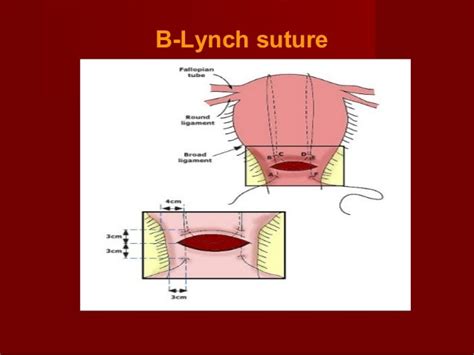 Random study...: B-Lynch sutures