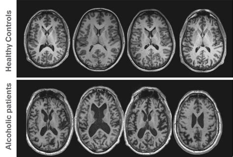 Brain Scans Mri