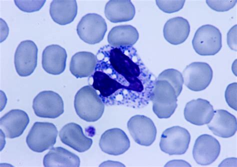 Jordans Anomaly in White Blood Cells | Medical Laboratories