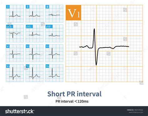 Patients Short Pr Interval Have No Stock Illustration 1954185532 | Shutterstock