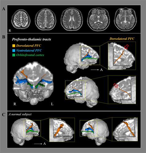 Relationship between short-term memory impairment and the dorsolateral prefrontal cortex injury ...