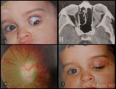 Optic Nerve Glioma Article