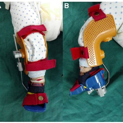 (PDF) A polyaxial fixation brace for the treatment of idiopathic congenital talipes equinovarus ...