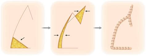 Rotation Flaps | Plastic Surgery Key