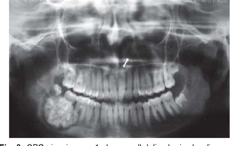 CEMENTO OSSIFYING FIBROMA PDF