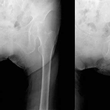 Details of study patients with occult fractures of the ischiopubic rami ...