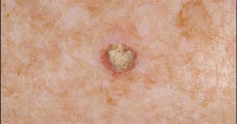 Actinic keratosis: potentially cancerous These spots feel rough and ...